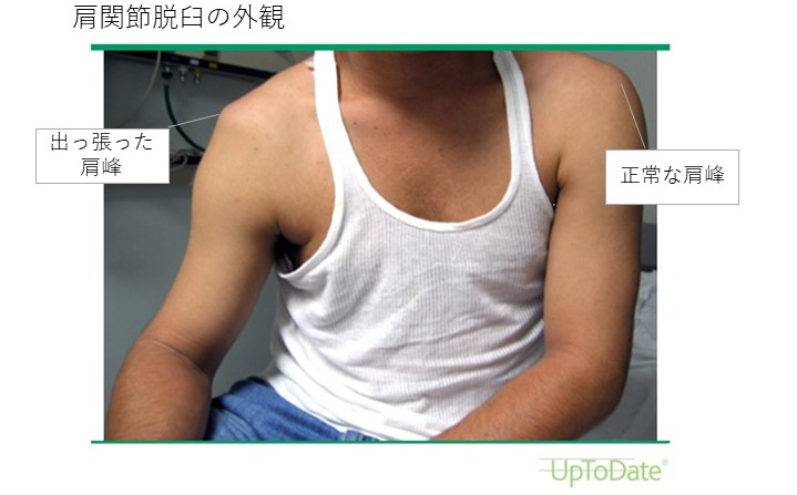 肩関節脱臼 かたかんせつだっきゅう 独立行政法人国立病院機構 霞ヶ浦医療センター